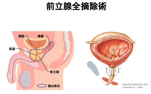 前立腺全摘除術