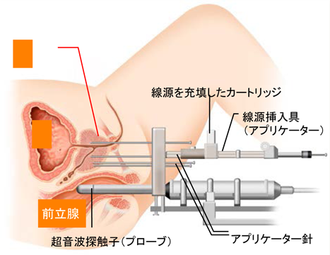 ヨウ素125密封小線源永久挿入療法