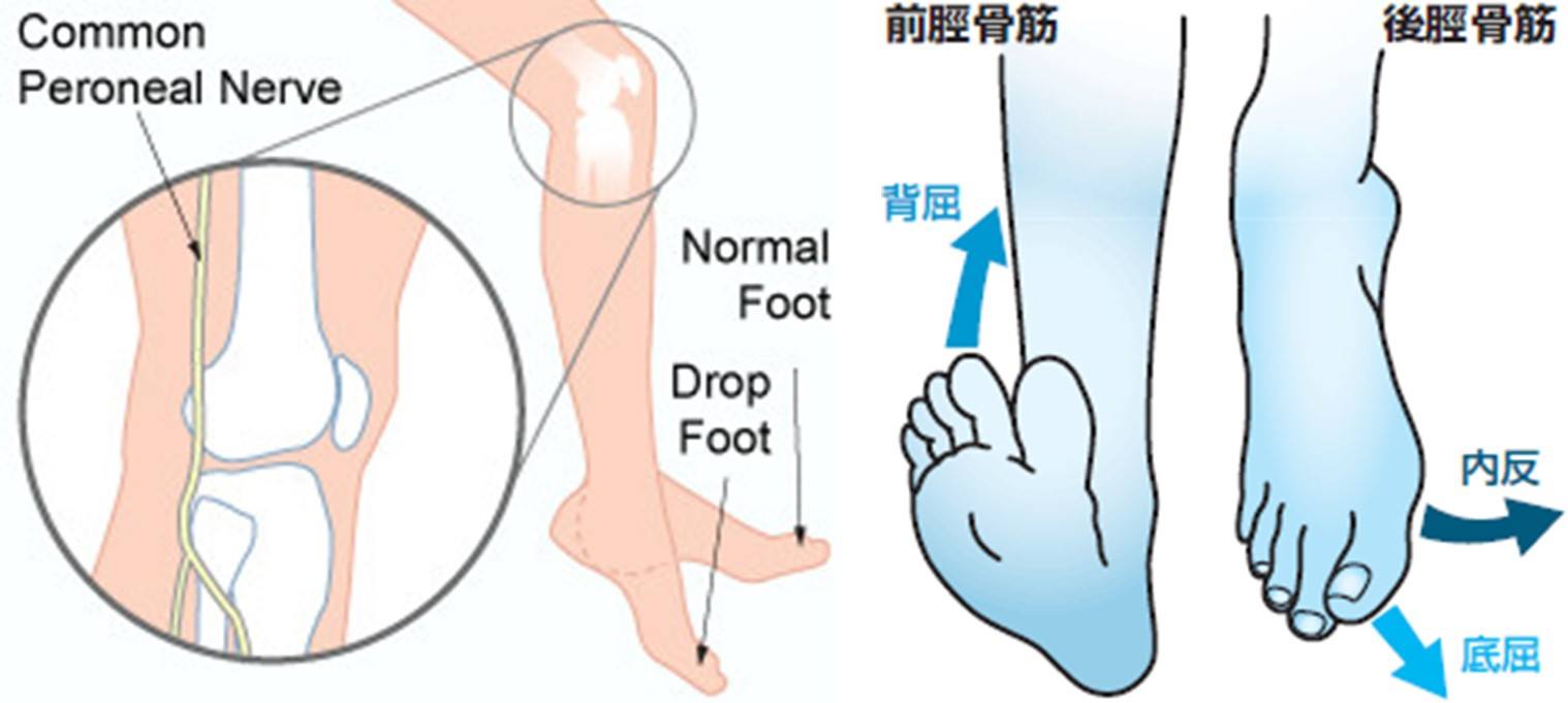 神経 麻痺 脛骨