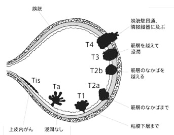 膀胱癌 - 患者さんへ | 岐阜大学大学院医学系研究科 泌尿器科