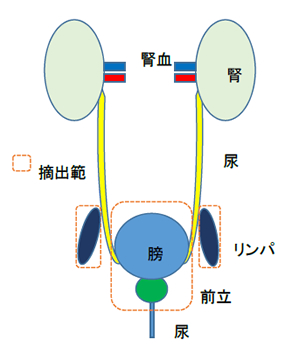 膀胱摘出手術と尿路変更術 摘出範囲