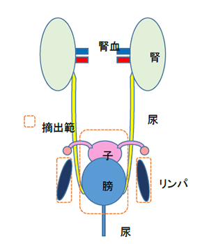 膀胱摘出手術と尿路変更術 摘出範囲