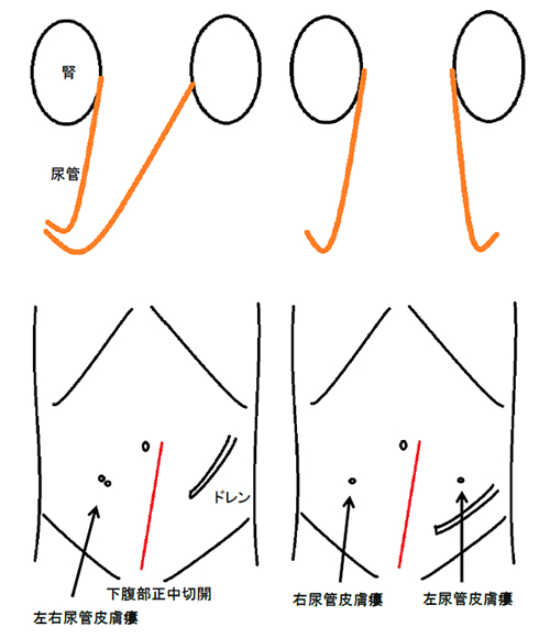 皮膚切開とストーマ
