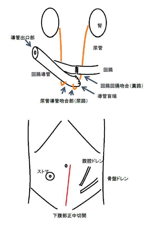 皮膚切開とストーマ