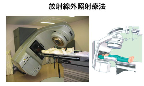 放射線外照射療法