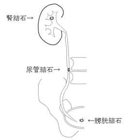尿道結石
